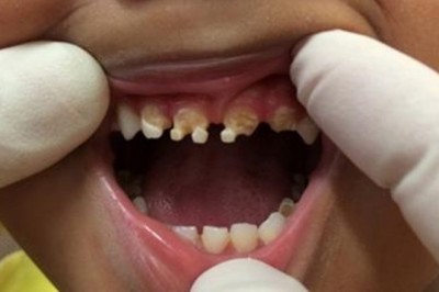 Dentysta jest w szoku kiedy zagląda w usta 3-letniego chłopca! Od razu pyta co dziecko dostaje do picia!