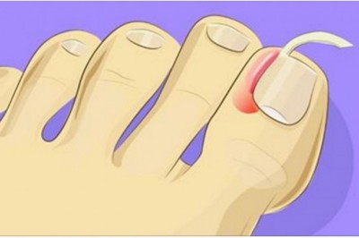 Zobacz jak w łatwy sposób poradzić sobie z wrastającymi paznokciami! Nie potrzebujesz pomocy lekarza!