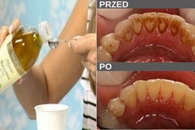 Zapomnij o nieświeżym oddechu, osadzie i bakteriach w ustach! Przy pomocy tylko jednego składnika dużo zmienisz!