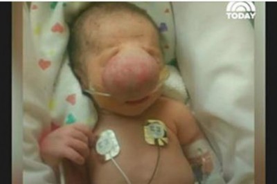 Lekarze usunęli wielką narośl z twarzy maluszka. To co było pod spodem sprawiło, że mieli łzy w oczach