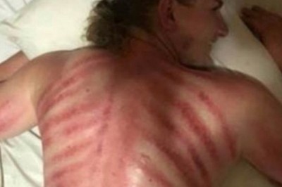 Zamówił  masażystę do pokoju podczas egzotycznych wakacji! Obudził się z czerwonymi pręgami na całych plecach 