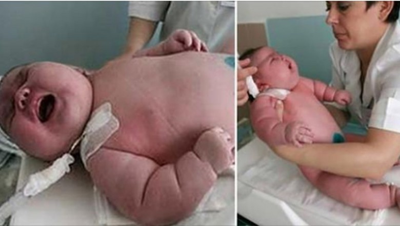 Ważąca 270 kg kobieta trafia w nocy do szpitala na porodówkę. Rodzi synka, którego waga to niemal 18 kg
