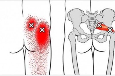 5 skutecznych sposobów na ból nerwu kulszowego. Mogą pomóc bardziej niż tabletki przeciwbólowe