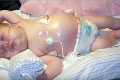 Lekarze orientują się, że w brzuszku dziecka coś zaczyna rosnąć. To samo widzą u jego bliźniaka