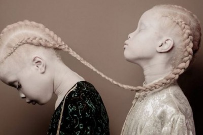 Bliźniaczki cierpiące na albinizm pozują do niezwykłej sesji. Lecz to wygląd 3 siostry budzi emocje