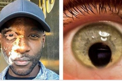 Ci ludzie dokładnie wiedzą co to znaczy być unikatowym. Natura stworzyła ich wyjątkowymi 