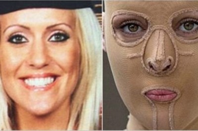 5 lat po oblaniu żrącą substancją zdecydowała się zdjąć maskę i pokazać światu swoją twarz