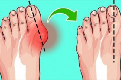 Masz problemy z haluksami? Zobacz jak złagodzić nieprzyjemne objawy w prosty sposób 