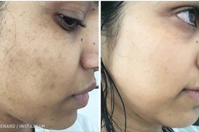 11 sposobów na usunięcie ciemnych przebarwień ze skóry