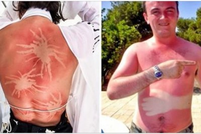 Te zdjęcia przypominają, że nie warto zasypiać na słońcu. Wygląda śmiesznie ale może być niebezpieczne