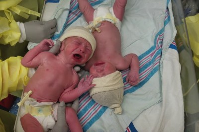 Po urodzeniu te bliźniaki nie przestawały płakać. Wystarczył jeden gest położnej