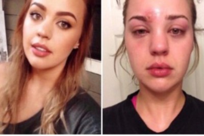 Robiąc makijaż zauważyła zgrubienie na brwi. Później poczuła dziwne objawy 