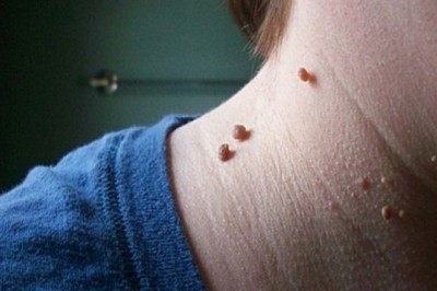 Prawie każdy je ma, lecz nie każdy wie, jak się ich pozbyć. Ta metoda zdecydowanie pomaga