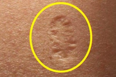 Z jakiego powodu po szczepieniu na ramieniu człowieka pojawia się blizna? Masz taką?