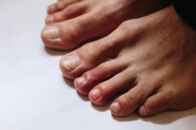 „Covidowe palce” to jeden z objawów zakażenia wirusem. Zobacz jak mogą wyglądać 