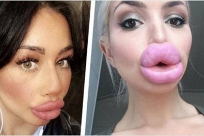Te kobiety zdecydowanie przesadziły powiększając swoje usta