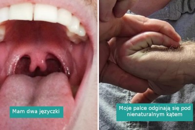 15 przypadków, w których natura postanowiła zagrać na genetycznej loterii