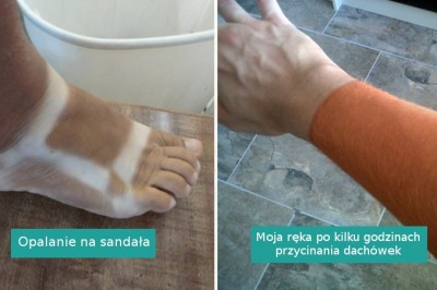 17 osób, które nieumyślnie przesadziły ze swoją opalenizną