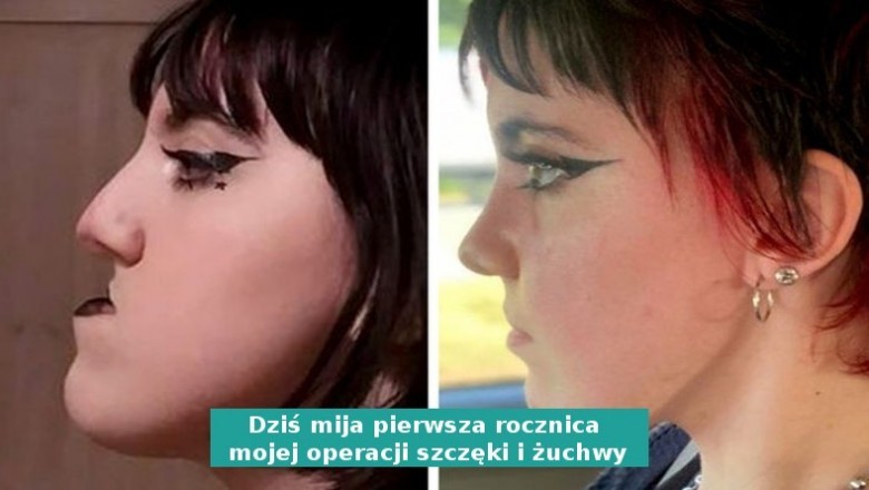 16 osób, które odważyły się na operację plastyczną i trafiły w dziesiątkę