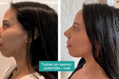 15 osób, które odważyły się na operację plastyczną i trafiły w dziesiątkę